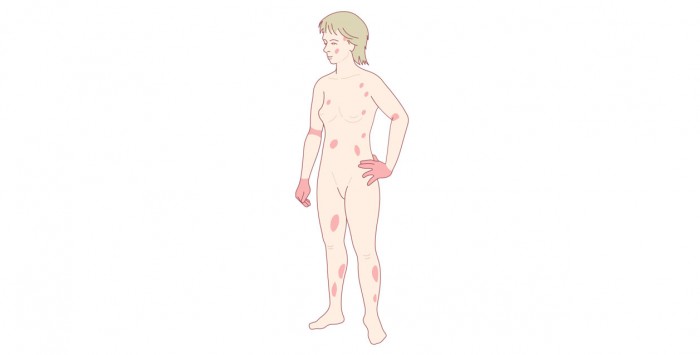 Adult eczema rash distribution