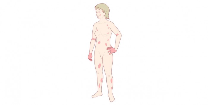 Adult eczema rash distribution