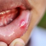 Mouth ulcer