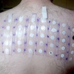 Allergy patch test