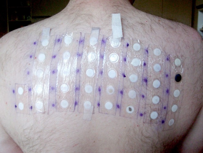 Allergy patch test