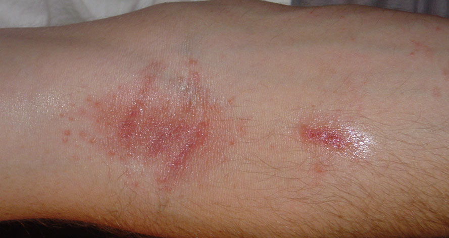 Contact Dermatitis Poison Ivy Rash