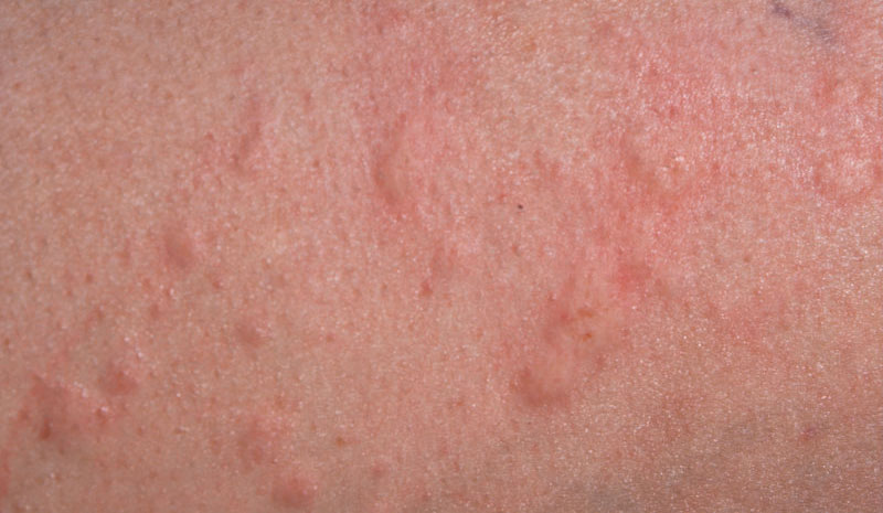 Hives Urticaria Allergies And Health